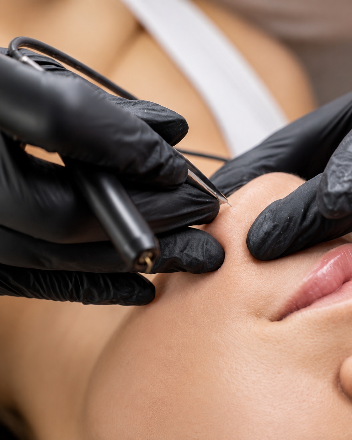 Thermolyse à Lieusaint chez MAELYA dermastudio